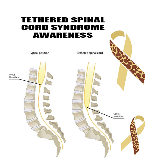 Tethered Spinal Cord Syndrome